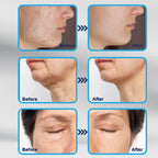 E DERMA STAMP 140 Adjustable 0-3mm