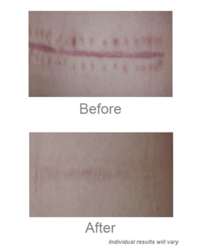 C Section Scar Silicone Strips for Surgical Scars, Tummy Tuck, C Section Recovery Must Haves - Silicone Scar Sheets - Large 7 inch, 8 Reusable Strips