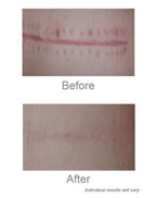 C Section Scar Silicone Strips for Surgical Scars, Tummy Tuck, C Section Recovery Must Haves - Silicone Scar Sheets - Large 7 inch, 8 Reusable Strips