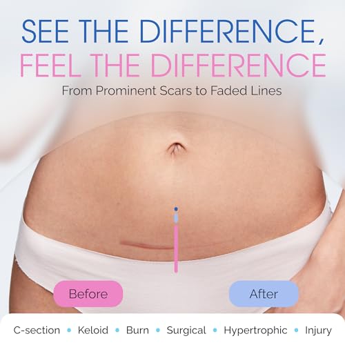 C Section Scar Silicone Strips for Surgical Scars, Tummy Tuck, C Section Recovery Must Haves - Silicone Scar Sheets - Large 7 inch, 8 Reusable Strips