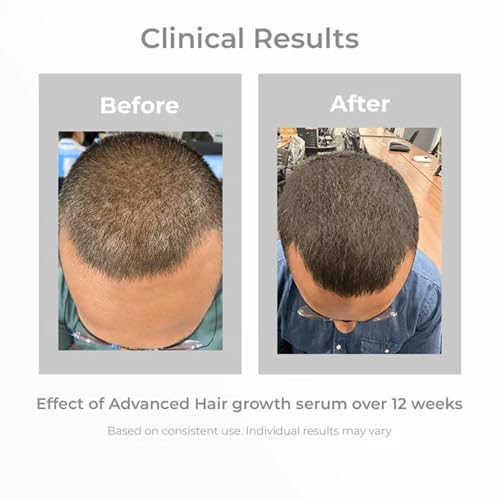 Pilgrim Advanced Hair Growth Serum | with 3% Redensyl + 4% Anagain | Stops Hair Loss & Hair Thinning | Hair Growth Treatment | Provides Thick & Dense Hair | 1.69 Fl Oz (50ml)