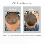 Pilgrim Advanced Hair Growth Serum | with 3% Redensyl + 4% Anagain | Stops Hair Loss & Hair Thinning | Hair Growth Treatment | Provides Thick & Dense Hair | 1.69 Fl Oz (50ml)
