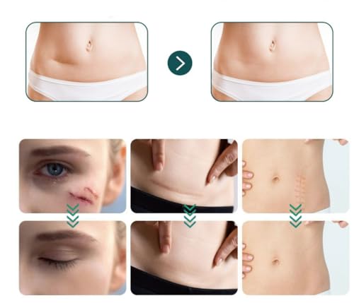 Losveo Silicone Scar Sheets For Face Wrinkles, 1.6”x 120”/3m Collagen Scar Tape Strips for Face,Medical Grade Silicone Scar Sheets for Surgical Scars,C-Section, Burn, Scars- Reusable(1box/3m)