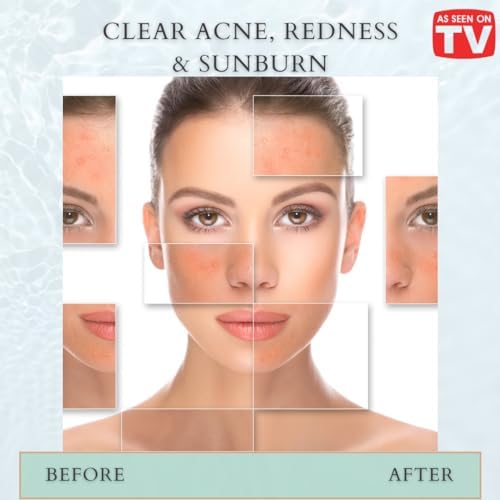 VoilaVe Pure Hypochlorous Acid Spray, All-in-One Skin Spray for Every Skin Type | HOCL Spray | Supports Acne, Scraps, Bruises, Rashes, Piercings, Tattoos, and Odors | Multi-Purpose Cleaner Spray 8 Oz