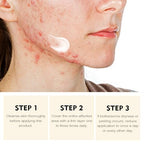 Acne Treatment for Face for Hormonal Cystic Stubborn Acne Cream for Sensitive Skin Teens Adults Women Men Spot Pimple Butt Control Rapid Clearing Breakout Overnight