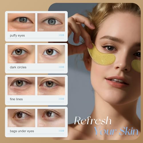 Mimido Under Eye Patches - Eye Patches for Puffy Eyes, eye masks for dark circles and puffiness (30 Pairs)