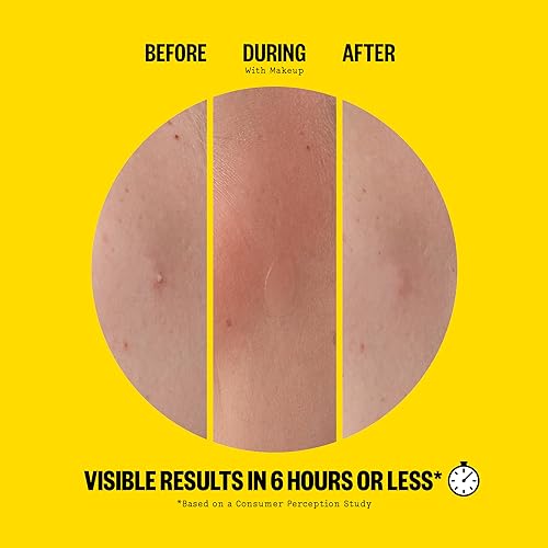 PEACE OUT Skincare Acne Day Dot Jumbo, 6-hour Fast Acting Sheer Hydrocolloid Pimple Patches with Salicylic Acid, Ultra-Thin, Virtually Invisible, Quickly Clear Breakouts, Blemishes and Zits, 40 dots