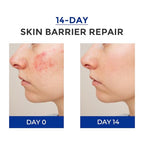 Intensive Repair Serum, 15% Hyaluronic Acid Serum with Ceramides and Centella Extract, Barrier Repair Redness Reilef Rosacea Treatment for Face Sensitive Acne Prone Skin, 30 Vials