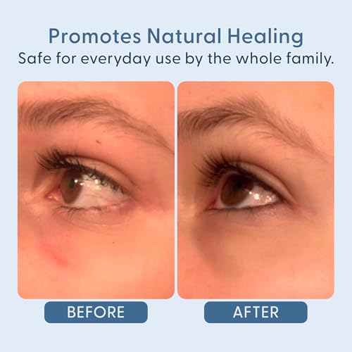 twenty/twenty Easy On The Eyes – 0.02% Hypochlorous Acid Spray to Cleanse Eyelashes – Reduce Eyelid Irritation – Safe for Sensitive Skin – Ophthalmologist Developed–Vegan, Clean Ingredients – 60ml
