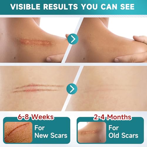 Silicone Scar Sheets, Silicone Scar Tape Strips(1.6”x 60” Roll-1.5M), Professional Away Sheets for Surgical Scars, Keloid, C-Section, Burn et