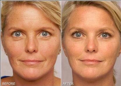 Retinol Gel 0.1 Vitamin A Repairs Fine Lines & Wrinkles, Scar Treatment, Age and Sun Spots, Anti-Aging Formula, 20 Grams
