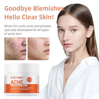 Acne Treatment for Face for Hormonal Cystic Stubborn Acne Cream for Sensitive Skin Teens Adults Women Men Spot Pimple Butt Control Rapid Clearing Breakout Overnight