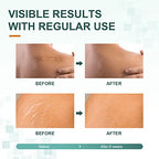 Silicone Scar Sheets,Tape, Strips - Healing Keloid, C-Section and Tummy Tuck - As Surgical Cream, Gel, Patch, Bandage, Pad - Surgery Scars Treatment - 6 Pack