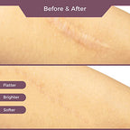 Silicone Scar Sheets - (1.6" x 120" Roll) Advanced Professional Medical Treatment for Scar Reduction, Painless Scar Removal Sheets for Surgical Scars, C-Section, Burns, Keloids