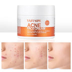 Acne Treatment for Face for Hormonal Cystic Stubborn Acne Cream for Sensitive Skin Teens Adults Women Men Spot Pimple Butt Control Rapid Clearing Breakout Overnight