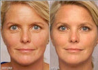 Retinol Gel 0.1 Vitamin A Repairs Fine Lines & Wrinkles, Scar Treatment, Age and Sun Spots, Anti-Aging Formula Gel 20 Grams