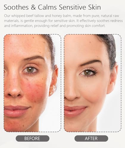 Beef Tallow for Skin (4 OZ), Whipped Beef Tallow and Honey Balm, Tallow Face Moisturizer, Grass Fed Beef Tallow for Face and All Skin Types