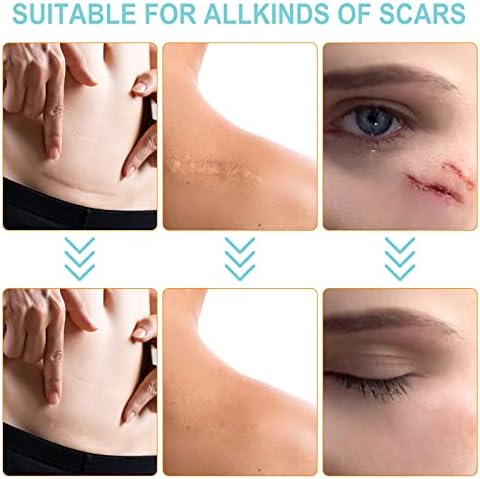 Silicone Scar Sheets (1.6” x 150”-3.8M), Medical Grade Soft Silicone Scar Tape, Strips, Roll - Keloid, C-Section, Surgical, Acne- Scars Removal Treatment, Painless Easy Removal, Reusable
