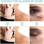 Silicone Scar Sheets (1.6” x 150”-3.8M), Medical Grade Soft Silicone Scar Tape, Strips, Roll - Keloid, C-Section, Surgical, Acne- Scars Removal Treatment, Painless Easy Removal, Reusable
