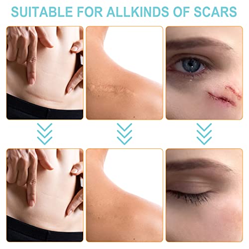Silicone Scar Sheets,Silicone Scar Tape Roll,Medical Grade Silicone Tape for Scar Removal,Professional Scar Treatment Patch for C-Section,Keloids,Surgical,Acne (Roll Size 1.6''x150''-3.8M)