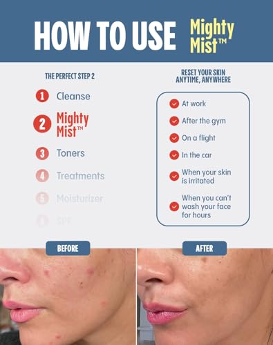Mighty Mist Premium Hypochlorous Acid Spray for Acne, Eczema, Rosacea | Safe for All Skin Types | Safe for Sensitive Skin | Soothes Irritation and Redness