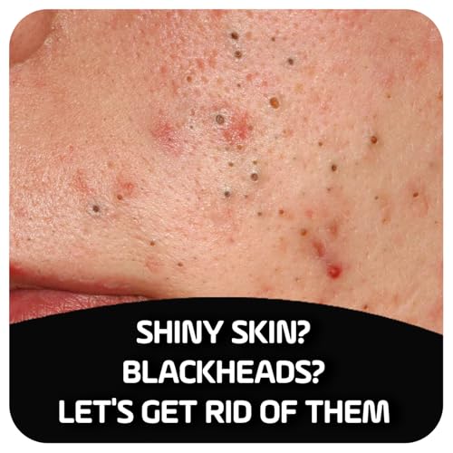 Asepxia Activated Charcoal Cleansing Bar for Enhanced Acne Control & Skin Purification with 2% Salicylic Acid, Ideal for Oily Skin and Reducing Blackheads - 4 Oz, 5-Pack