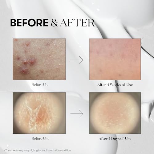 VT COSMETICS CICA Reedle Shot 100, Spicule Microneedling Serum for Pore Care & Exfoliation, Exosome, Centella Asiatica for Glass Skin, Skin Texture, Korean Liquid Skin Booster (1.69 Fl Oz / 50ml)