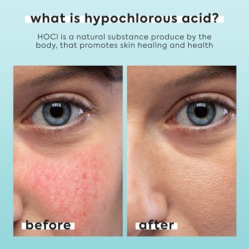 Hypochlorous Acid Spray for Face & Body, Helps Reduce Redness and Breakouts, Hypochlorous Spray, Multi-Purpose Topical Facial Skin Repair, pH-Balancing Toner, TSA Travel Size, Livaclean
