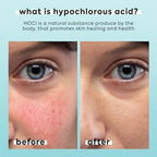 Hypochlorous Acid Spray for Face & Body, Helps Reduce Redness and Breakouts, Hypochlorous Spray, Multi-Purpose Topical Facial Skin Repair, pH-Balancing Toner, TSA Travel Size, Livaclean