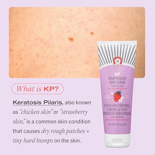 First Aid Beauty - KP Bump Eraser Body Scrub with 10% AHA, Keratosis Pilaris Exfoliater with Glycolic and Lactic acids, Helps Reduce Chicken Skin Bumps, Safe for Sensitive Skin, Strawberry Scent, 2 oz