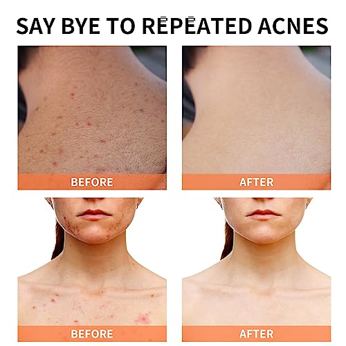 Acne Treatment for Face for Hormonal Cystic Stubborn Acne Cream for Sensitive Skin Teens Adults Women Men Spot Pimple Butt Control Rapid Clearing Breakout Overnight