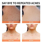 Acne Treatment for Face for Hormonal Cystic Stubborn Acne Cream for Sensitive Skin Teens Adults Women Men Spot Pimple Butt Control Rapid Clearing Breakout Overnight
