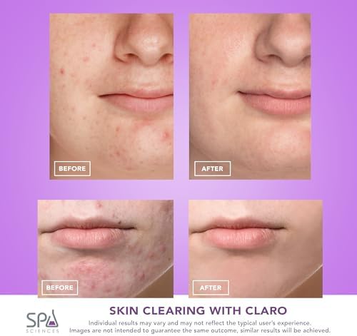 Spa Sciences CLARO Clinically Proven Blue & Red LED Acne Treatment Light Therapy System-FDA Cleared-Rechargeable- Professional Home Acne Healing/Clearing Treatment