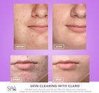 Spa Sciences CLARO Clinically Proven Blue & Red LED Acne Treatment Light Therapy System-FDA Cleared-Rechargeable- Professional Home Acne Healing/Clearing Treatment