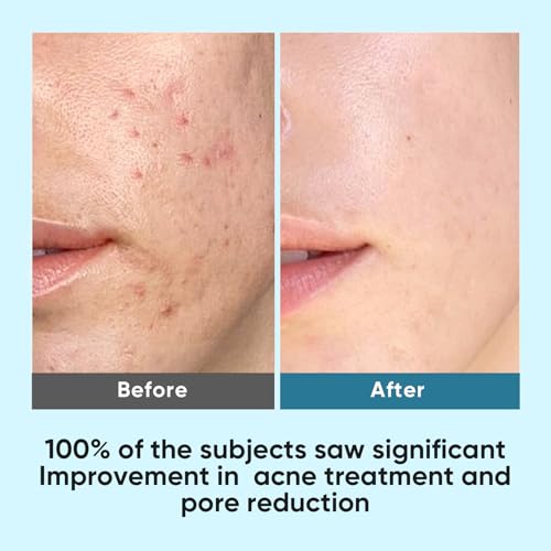 Elvira Korean Skincare Anti-Aging & Glycolic Acid Exfoliating Facial Pads With 10% Glycolic Acid, 2% Salicylic Acid & Niacinamide - 60 Toner Pads, Daily Peel Treatment for Acne Prone Sensitive Skin