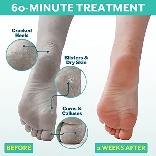 Patchology PoshPeel Pedi Cure - Foot Peel Mask Soak Treatment, Pedicure Foot Spa, Feet Peeling Mask, Pedicure Booties w/Deep Exfoliation for Baby-soft Skin, Pedicure Supplies for Foot Care, 1 Pair