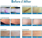 Aroamas Scar Silicone Scar Tape– Softens & Flattens Scars from Surgery, Injury, Burns, C-Section, Scratch Marks – Reusable Medical-Grade Silicone Scar Sheets for All Skin Types [3"x1.57", 8 Sheets]