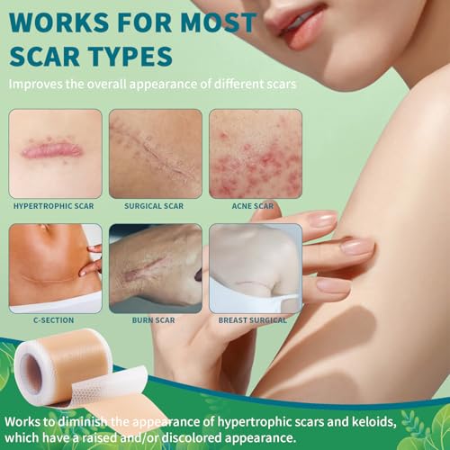 Silicone Scar Sheets, Silicone Scar Tape, Scar Sheets for Surgical Scars, Reusable Silicone Scar Strip For Surgical, C-Section,Tummy Tuck, Keloid Scars, Burn, Acne, Removal (1.6"X 108" Roll-3M)