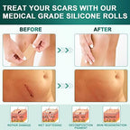 Silicone Scar Sheets, Silicone Scar Tape (1.6"x 120" Roll-3M), Reusable and Effective Scar Removal Sheets, Silicone Scar Removal Sheets for Surgical Scars, Healing Keloid, C-Section, Tummy Tuck