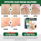 Silicone Scar Sheets,Silicone Scar Tape,Silicone Sheets For Scars,Scar Tape For Surgical Scars,Keloid Bump Removal,Scar Removal For Surgical(1.6"x 120" Roll-3M)