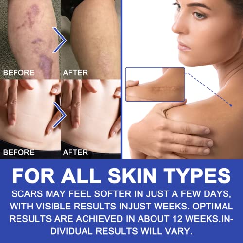 Silicone Scar Sheets - Gel Silicone Scar Tape (1.6” x 120”), Invisible Medical Grade Scar Silicone Strips, Transparent Removal Scar Patches for Keloids, Burn, C-Section, Acne