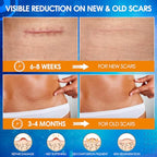 Silicone Scar Sheets (1.6" X 120" Roll), Medical Grade Silicone Scar Tape, Soft Silicone Scar Patches for Surgical Scars, C Section, Keloid, Tummy Tuck, Burn