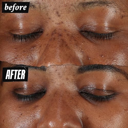 Kiehl's Clearly Corrective Dark Spot Serum, Brightening Facial Serum, Reduces Hyperpigmentation & Post-acne Marks, with Vitamin C & Salicylic Acid, All Skin Types, Paraben-free, Mineral Oil-free