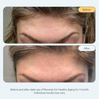Remedy for Healthy Aging - Anti-Aging Treatment for Wrinkles, Uneven Texture & Tone with Retinaldehyde, Argireline, Matrixyl 3000, Glycolic Acid, Ferulic Acid - By Dermatologist Dr. Shah