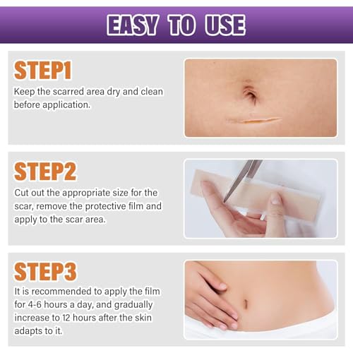 Silicone Scar Sheets,Silicone Scar Tape,Scar Tape for Surgical,C-Section,Tummy Tuck,Keloid(1.6"X 120" Roll-3M) Keloid Bump Removal