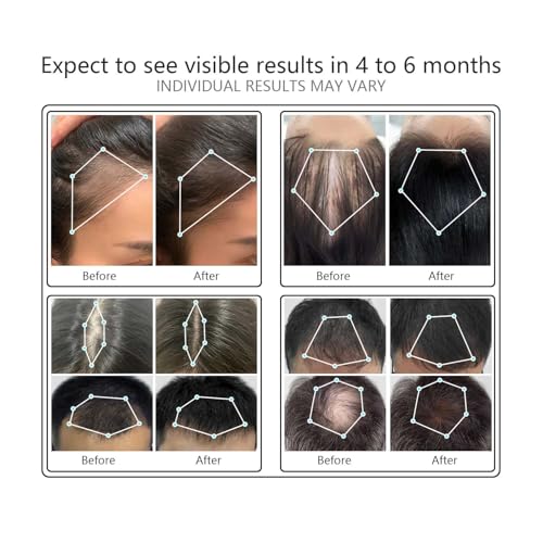 Laser Comb, Red Light Therapy for Hair Growth, Medical Grade Hair Loss Treatment Regrows Fuller and Thickness, Reverses Thinning, Stimulates Growth for Men & Women