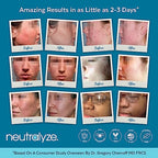 Exfoliating Acne Treatment Pads - 100 Dual Textured Face Wipes with 2% Salicylic Acid & 2% Mandelic Acid - Toner Pads for Acne Prone Skin, Face & Body Wipes for Teens & Adults