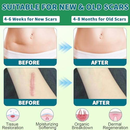Silicone Scar Sheets, Silicone Scar Tape, Scar Sheets for Surgical Scars, Reusable Silicone Scar Strip For Surgical, C-Section,Tummy Tuck, Keloid Scars, Burn, Acne, Removal (1.6"X 108" Roll-3M)