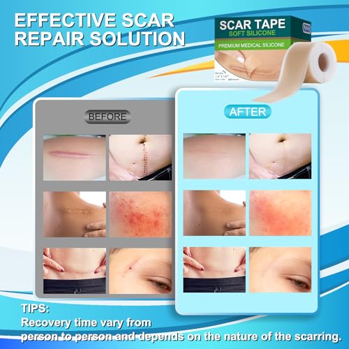 Medical Grade Silicone Scar Tape for Surgical Scars (1.6" x 157" - 4M) Professional Silicone Scar Sheets Scar Treatment for Face Wrinkles, C Section Recovery, Keloid Bump Removal Silicone Scar Patches