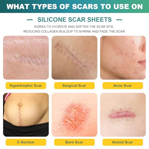 Silicone Scar Sheets (1.6" x 120" Roll-3M), Silicone Scar Tape for Scar Removal Treatment, Silicone Scar Removal Strips for Surgical, C-Section, Tummy Tuck, Keloid Bump Removal